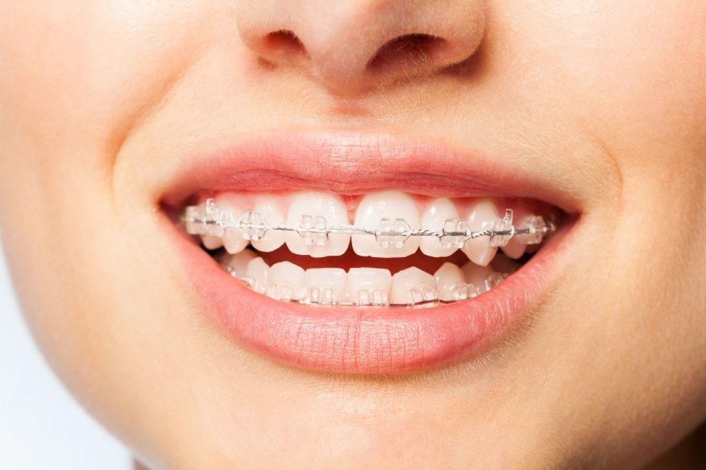Invisible Aligners